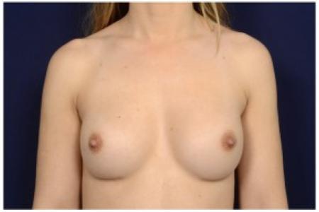 After image 1 Case #86271 - 26 year old woman treated with Breast Augmentation