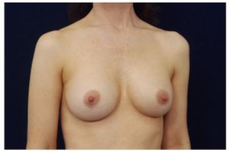 After image 2 Case #87036 - Breast Augmentation