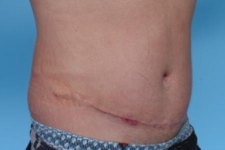 After image 2 Case #82221 - Male Liposuction