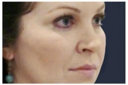 After image 2 Case #86326 - 40 year old woman treated with Voluma