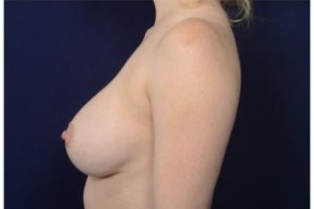 After image 3 Case #86866 - Breast Augmentation