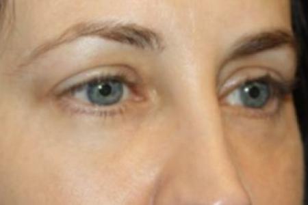 After image 2 Case #84531 - Blepharoplasty - Lower Lids Only - 41 year old female