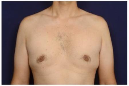 After image 1 Case #84501 - Gynecomastia