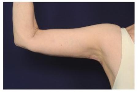 After image 1 Case #86996 - Upper Arm Lift
