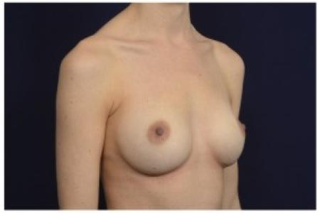 After image 2 Case #86926 - Breast Augmentation
