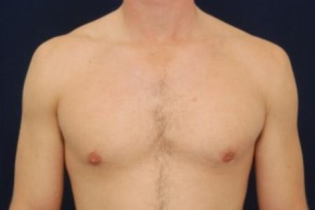 After image 1 Case #87741 - Gynecomastia
