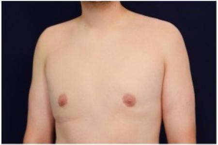After image 2 Case #82071 - Gynecomastia