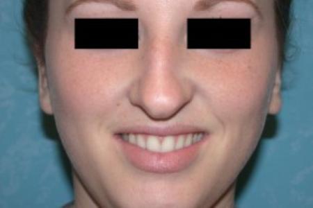 After image 1 Case #81676 - Bilateral Otoplasties