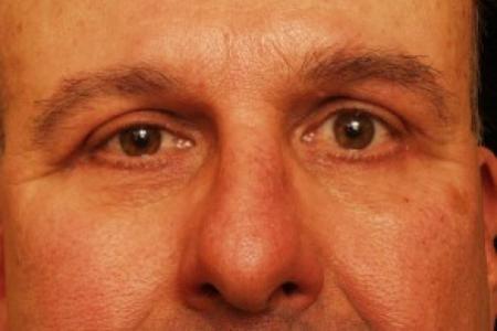 After image 1 Case #81731 - Eyelid Surgery