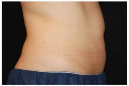 After image 3 Case #86351 - 37 year old woman treated with nonsurgical fat reduction.