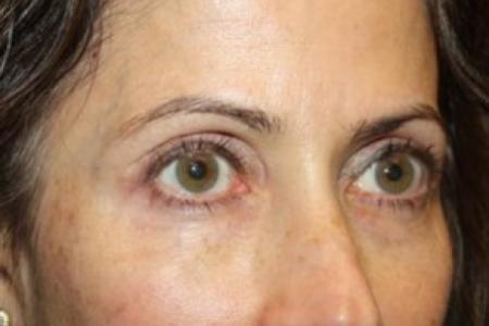 After image 2 Case #84886 - Upper LidBlepharoplasty & Brow Lift - 50 year old female