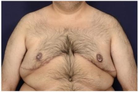 After image 1 Case #86921 - Gynecomastia
