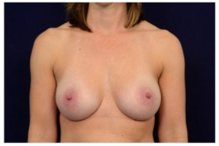 After image 1 Case #87011 - Breast Augmentation