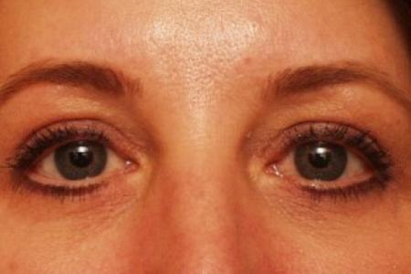 After image 1 Case #81746 - Eyelid Surgery