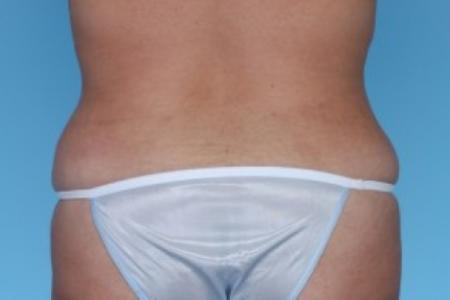 After image 1 Case #82266 - Liposuction
