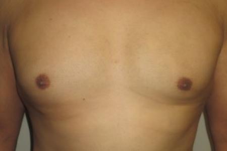 After image 1 Case #82406 - 37 Male Gynecomastia