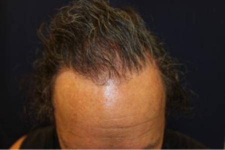 After Case #87381 - Hair Transplantation San Diego