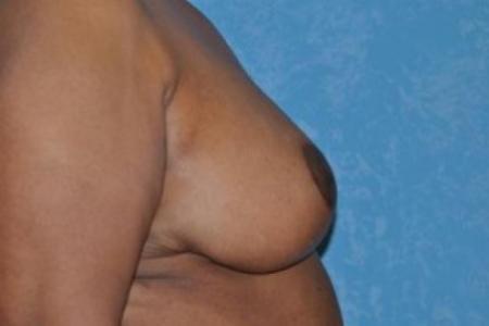 After image 2 Case #83411 - Breast Reduction 