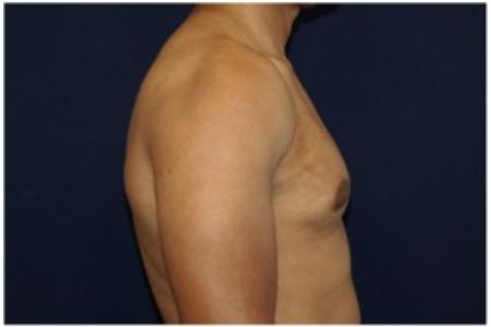 After image 3 Case #82076 - Gynecomastia