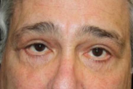 After image 1 Case #84216 - Blepharoplasty - 61 year old male