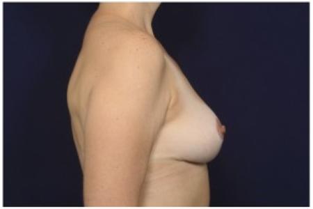 After image 3 Case #86296 - 43 year old woman treated with Breast Reduction