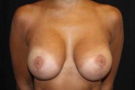 After image 1 Case #84836 - Breast Lift with Implants - 28 year old female.