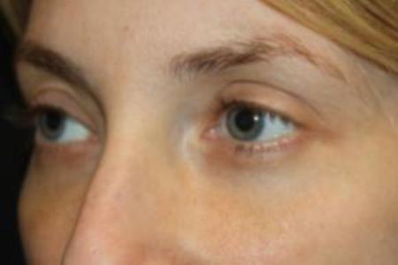 After image 2 Case #85876 - Blepharoplasty - Lower Lids Only - 34 year old female