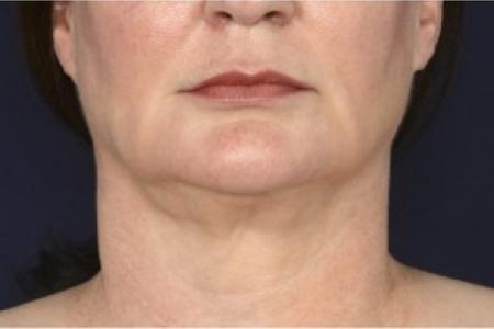 After image 1 Case #87041 - Lower Facial Rejuvenation 