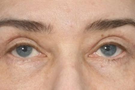 After image 1 Case #87451 - Eye Area Rejuvenation