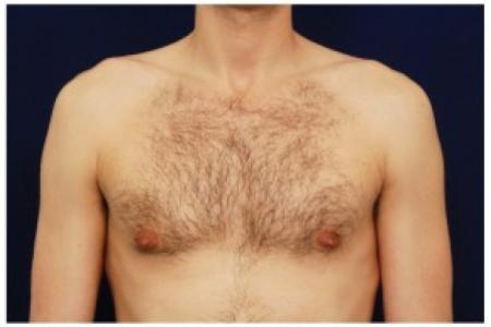 After image 1 Case #82161 - Gynecomastia