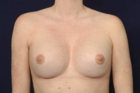 After image 1 Case #87456 - Breast Augmentation