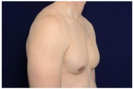 After image 2 Case #85596 - Gynecomastia