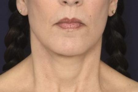 After image 1 Case #87436 - Lower Facial Rejuvenation 