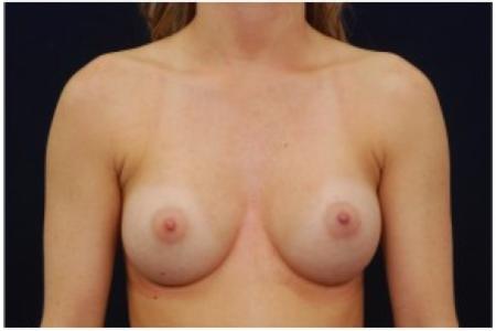 After image 1 Case #81966 - Breast Augmentation