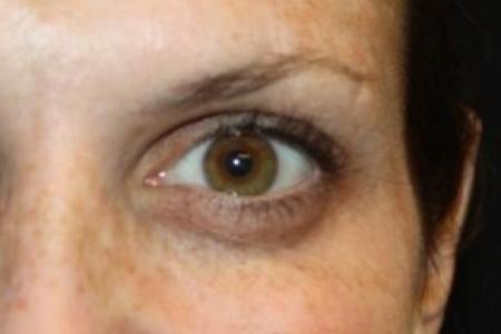 After image 1 Case #83891 - Botox (Crows Feet Only) - 34 year old female.