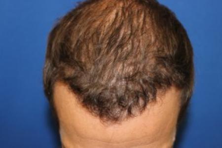 After Case #87396 - Hair Transplantation San Diego