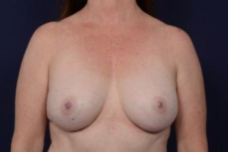 After image 1 Case #87616 - Breast Augmentation