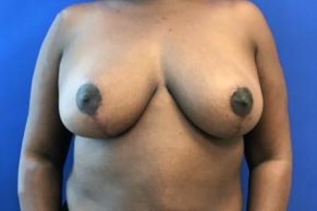 After image 1 Case #88266 - Breast reduction on a 47 year old female