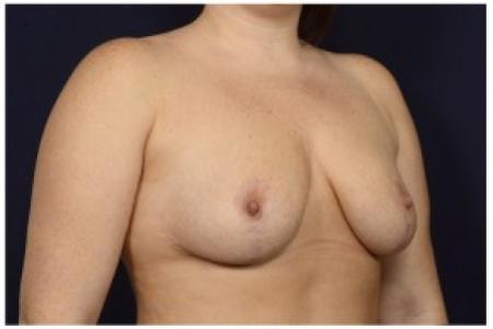 After image 2 Case #84771 - Bilateral Breast Reduction