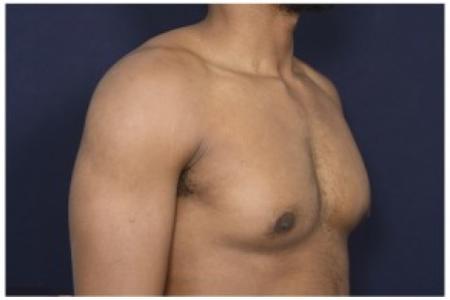 After image 2 Case #84491 - Gynecomastia