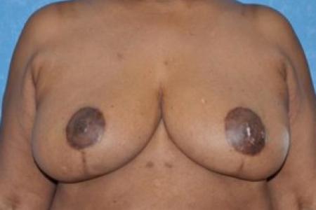 After image 1 Case #83411 - Breast Reduction 