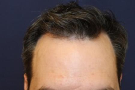 After image 1 Case #87376 - Hair Transplantation San Diego