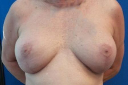 After image 1 Case #87291 - Breast Augmentation Revision with Mastopexy