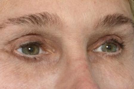 After image 2 Case #87131 - Structural Fat Grafting