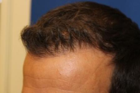 After Case #87396 - Hair Transplantation San Diego