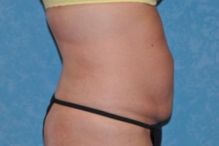 After image 2 Case #83951 - Liposuction Before and After 