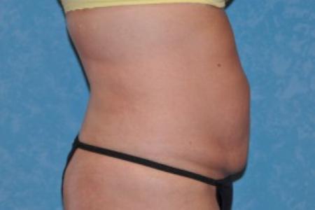 After image 2 Case #83951 - Liposuction Before and After 