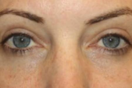 After image 1 Case #85846 - Blepharoplasty - Upper and Lower Lids - 42 year old female