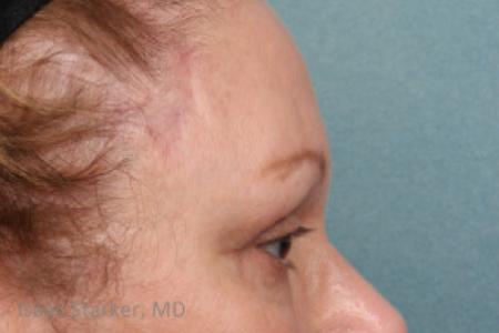 After image 2 Case #88181 - Upper and Lower Eyelid Lift with Lateral Brow Lift
