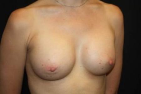 After image 2 Case #84926 - Breast Augmentation - 33 year old female